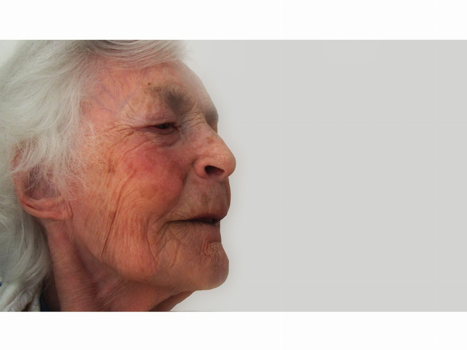 Les taches de vieillesse ou taches brunes : causes et preventions.